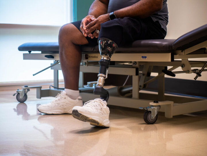 Patient with a custom leg prosthetic